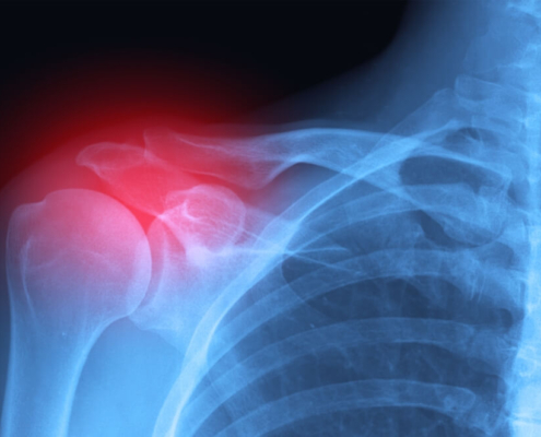 Repetitive Motion Injuries in Linemen: Carpal Tunnel, Tendinitis, and Legal Recourse