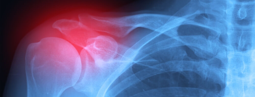 Repetitive Motion Injuries in Linemen: Carpal Tunnel, Tendinitis, and Legal Recourse